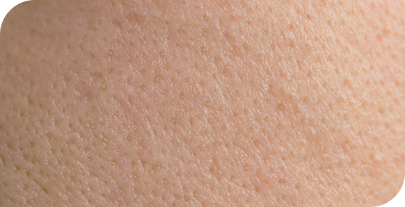 Extreme close-up van de huidtextuur, waarop vergrote poriën zichtbaar zijn die de huid een onregelmatig oppervlak geven.