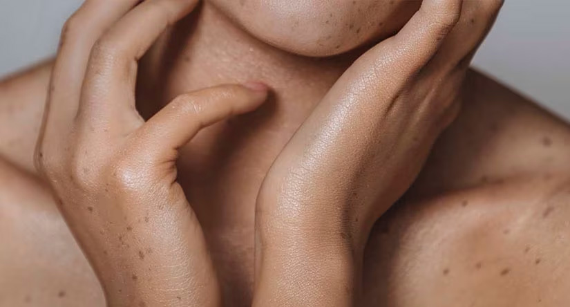 Close-up van een persoon met sproeten op de huid. De handen omlijsten zachtjes de hals en kin.